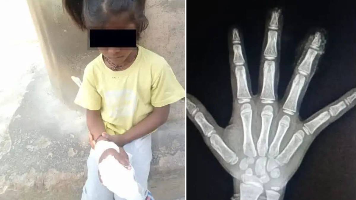 ಮಾನವೀಯತೆ ಮರೆತ ಶಿಕ್ಷಕ - ವಿದ್ಯಾರ್ಥಿನಿಯ ಬೆರಳು ಕಟ್ ಆದ್ರೂ ಕಿಂಚಿತ್ತು ಸ್ಪಂದಿಸದ ಶಾಲಾ ಘಟನೆ!!