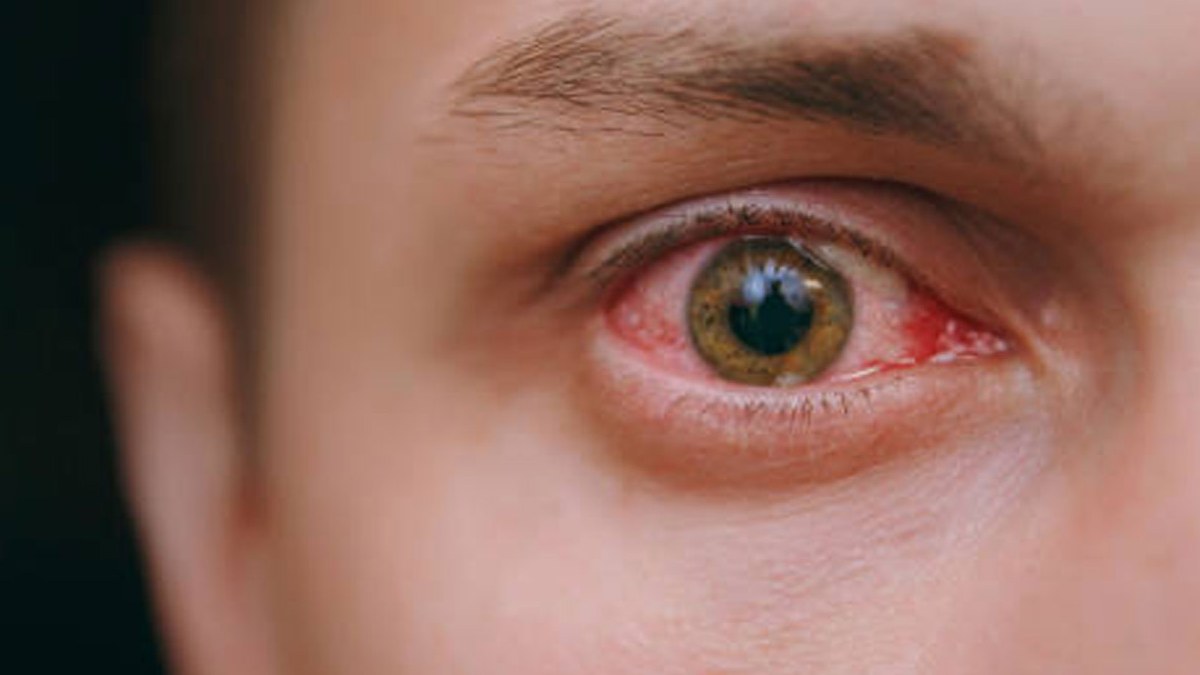 Red Alert in Chennai: ‘Madras Eye’ Cases Surge as Doctors Link Rapid Spread to Climate Stress and Pollution