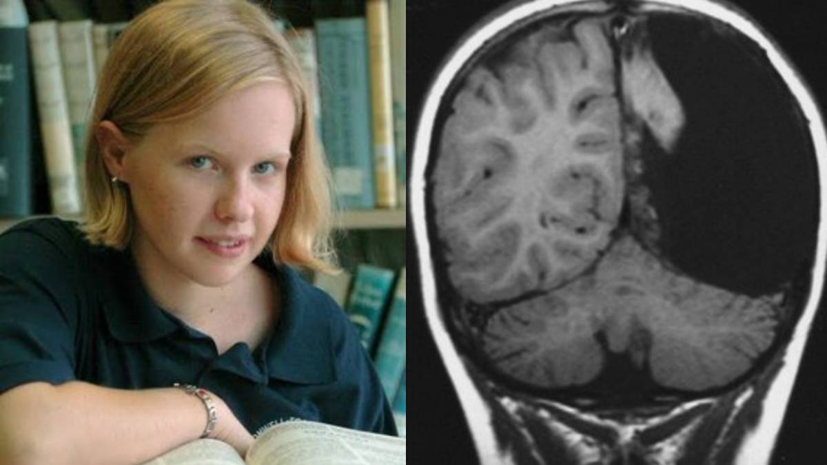 ಅರ್ಧ ಮೆದುಳು ಇಲ್ಲದಿದ್ದರೂ ಮಾಸ್ಟರ್ ಡಿಗ್ರಿ ಮುಗಿಸಿದ ಸಾಧಕಿ - ವೈದ್ಯಕೀಯ ಲೋಕವೇ ಬೆರಗಾದ ಛಲಗಾರ್ತಿ ಕಥೆ ಇದು!!