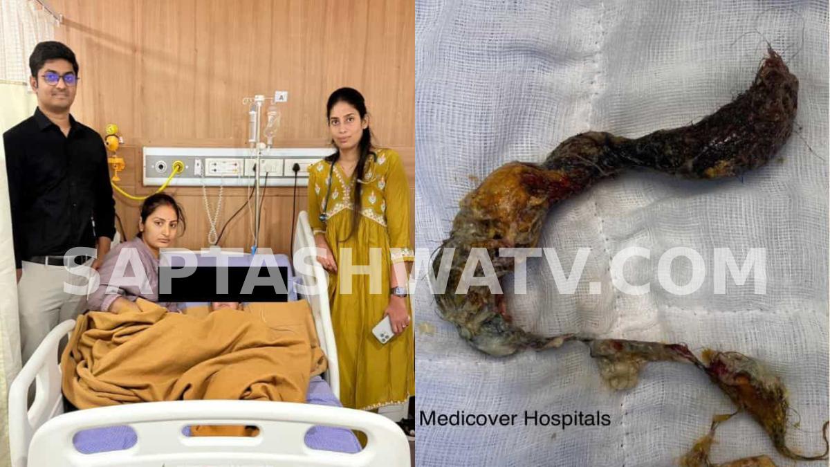 Doctors Remove 25 cm Hairball From Child’s Stomach in Rare Pica Disorder Case