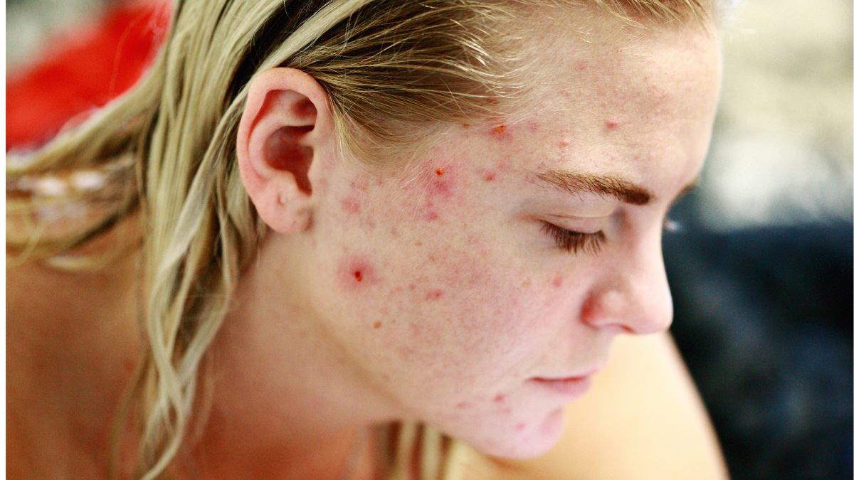 Natural Acne Scar Treatment: Effective Ways to Heal and Renew Your Skin