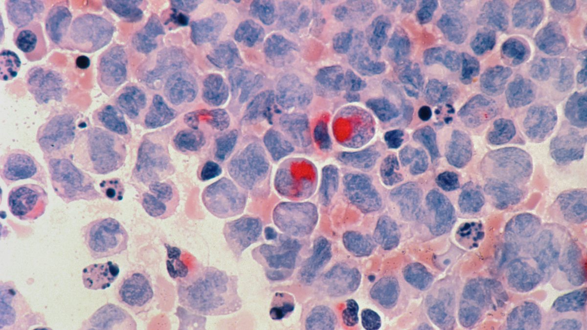 Normal Blood Test, But Still Cancer? Here’s What Doctors Want You to Know