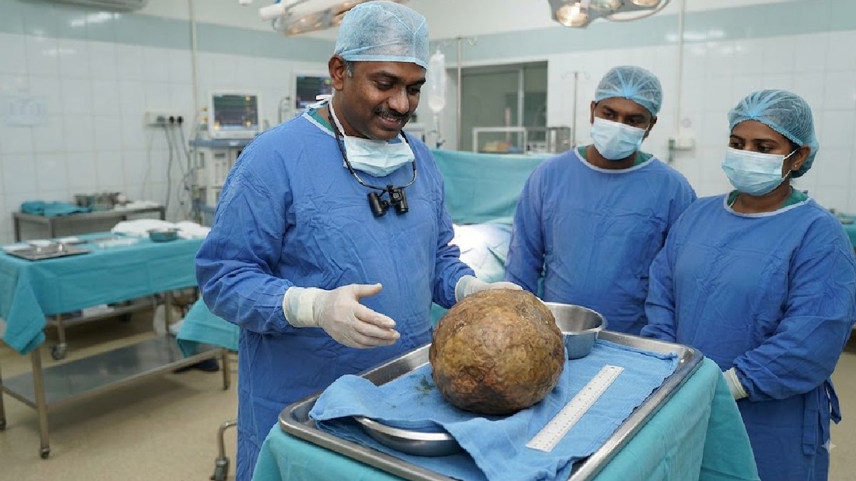 Sri Lankan Doctors Remove Massive 3.1kg Bladder Stone, Potentially the Largest Ever Recorded