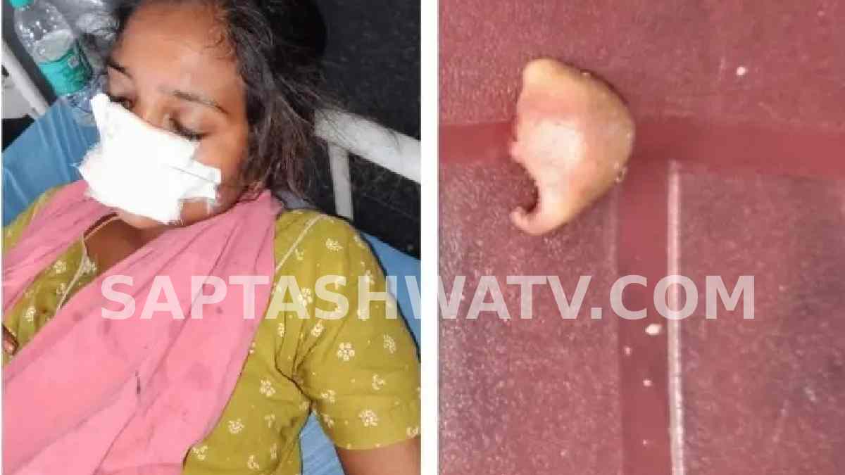Telangana Man Allegedly Bites Off Part of Wife’s Nose During Family Dispute