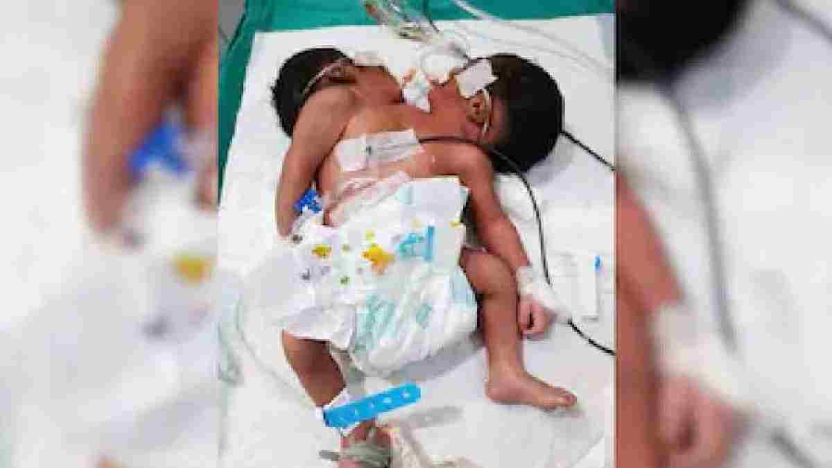 Odisha Conjoined Twins Die After One Week | Photo Credit: https://x.com/c_susim