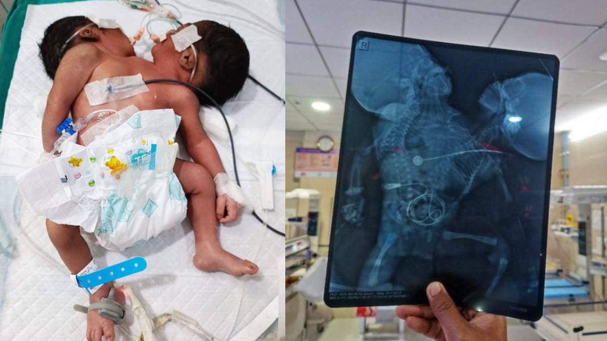 Odisha Rare Conjoined Baby Born With Two Heads | Photo Credit: https://x.com/ArchanaSatapat1